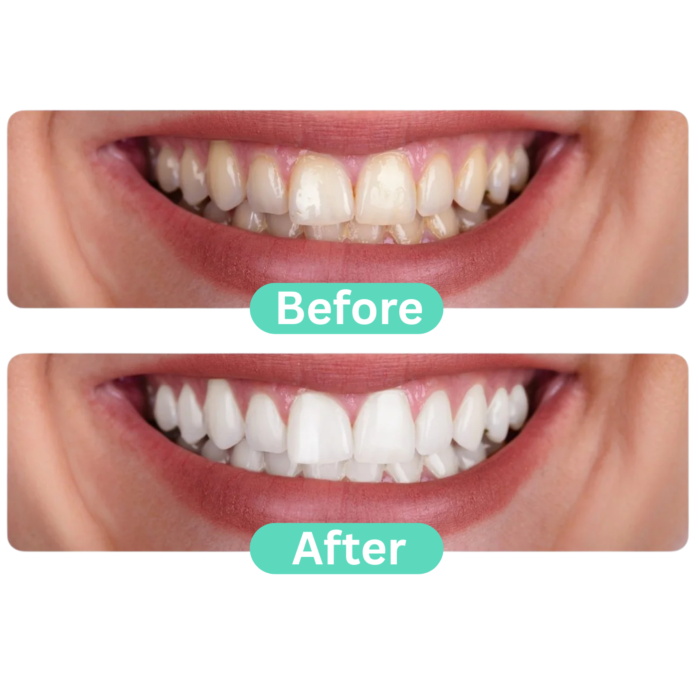 Before and after results using the best Portable Water Flosser – Cordless Rechargeable Oral Irrigator for Cleaner Teeth, Healthier Gums, and Fresher Breath